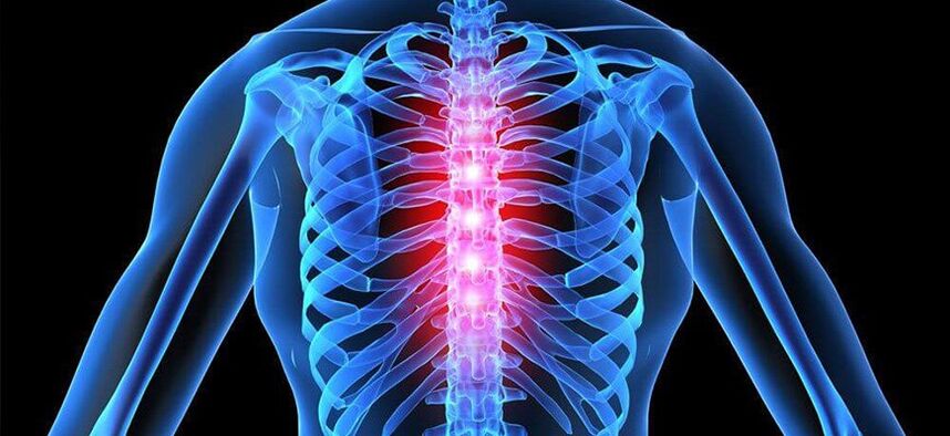 Az akut fájdalom a mellkasi gerinc osteochondrosisának súlyosbodására jellemző