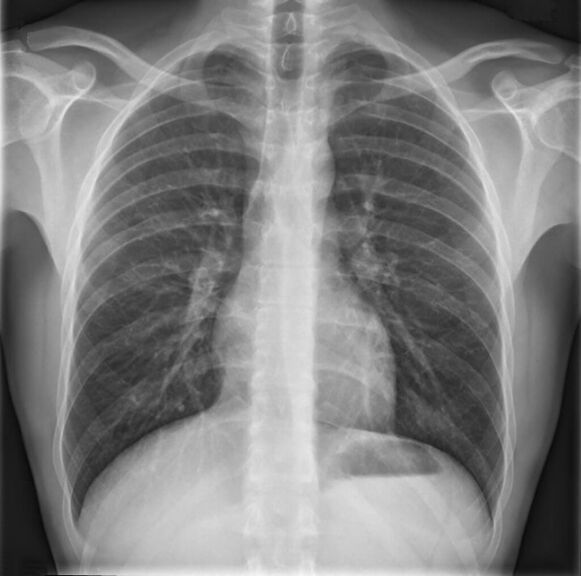 A mellkasi gerinc osteochondrosisát radiográfia segítségével diagnosztizálják