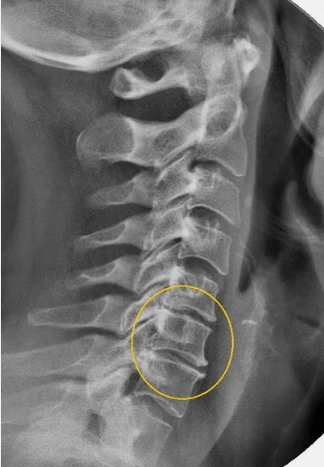 A méhnyak gerincének osteochondrosis egy x -seriségen