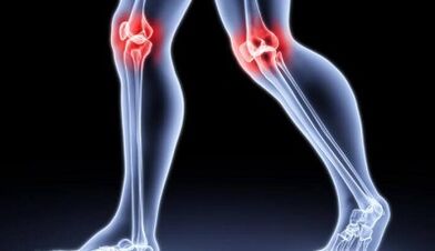 Az ízületi gyulladás és arthrosis kialakulásának megelőzése