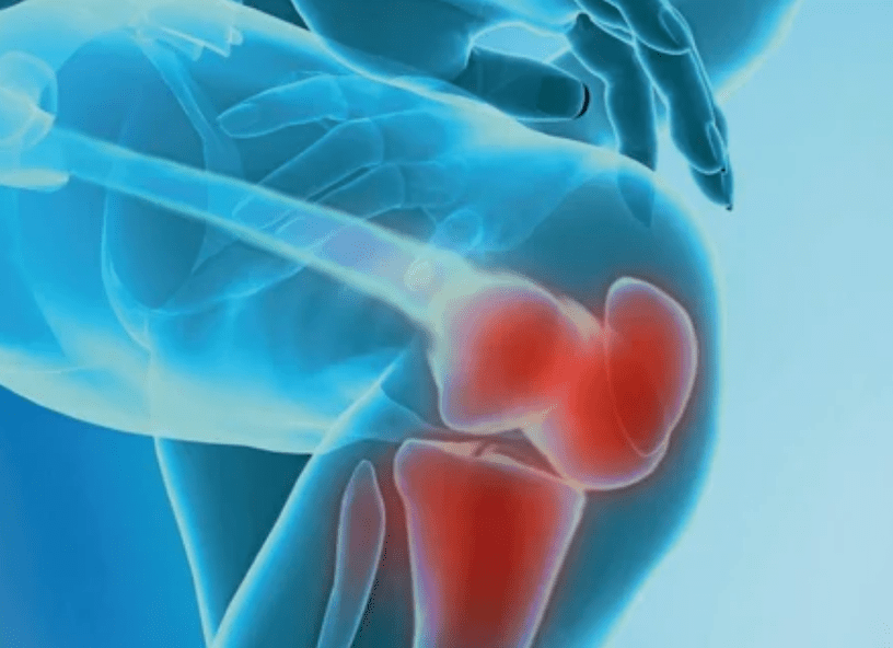 Mi az arthrosis