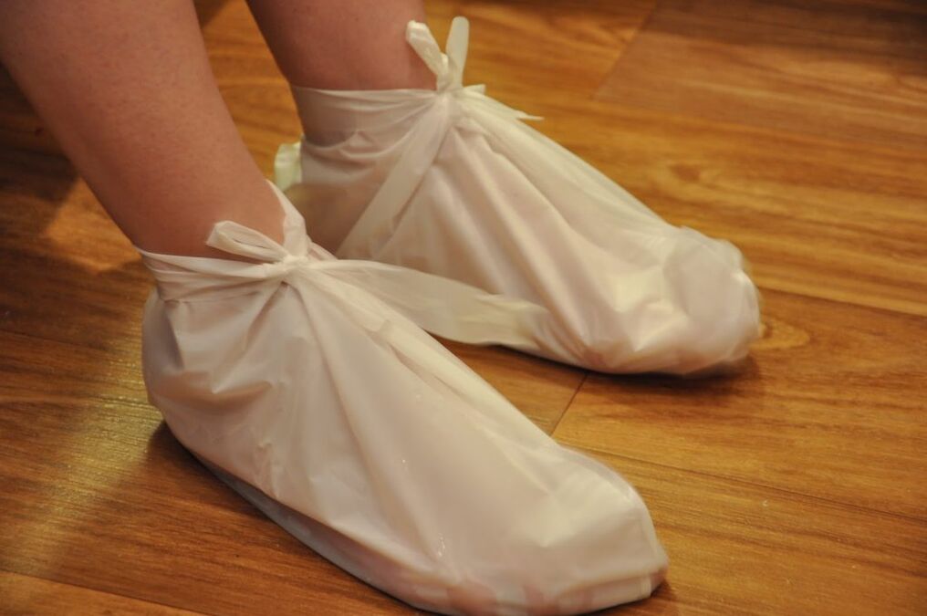 borogatás boka arthrosis esetén