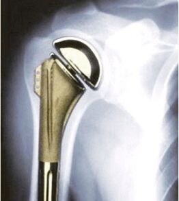Vállprotézis arthrosis esetén