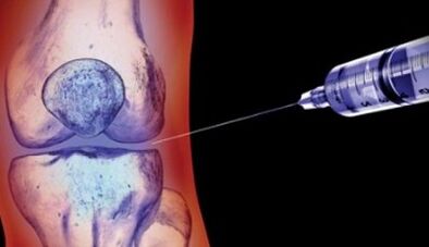 Az ízületi arthrosis kezelésének módszerei