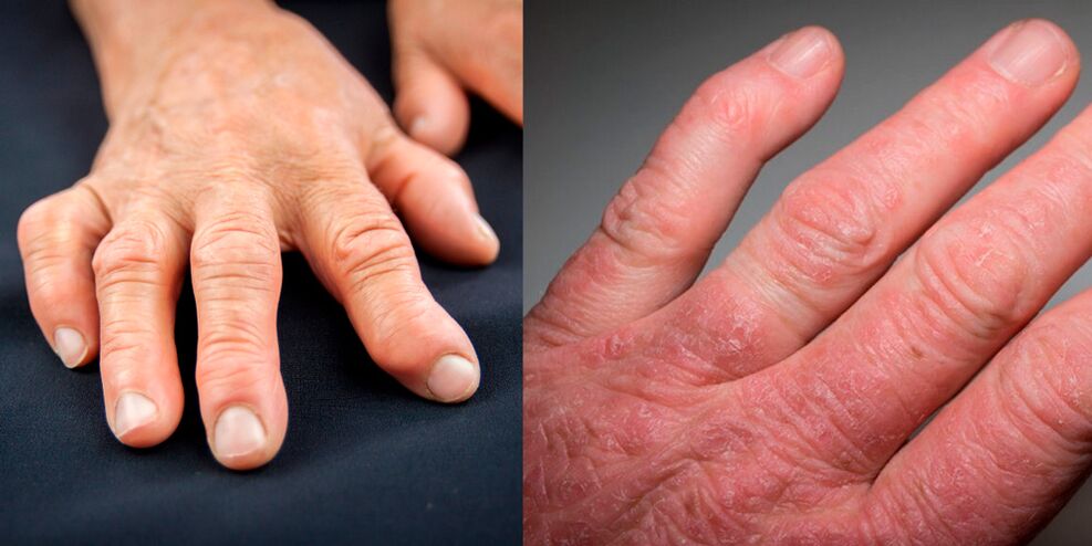a kezek reumatoid és psoriaticus ízületi gyulladása