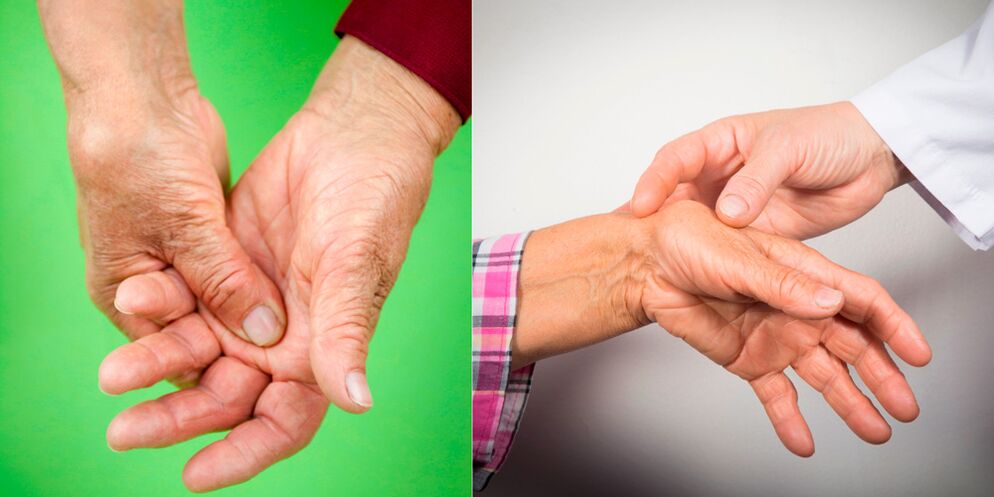 duzzanat és fájó fájdalmak a kéz ízületi gyulladásának első jelei