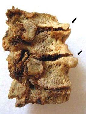 Az osteochondrosis által érintett csigolya szakasz